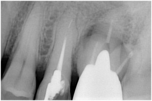 篠崎２ GBR　拡大写真・骨吸収像